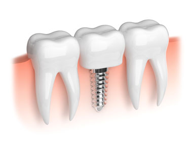 Visit An Implant Dentist In West Grove To Restore Your Smile