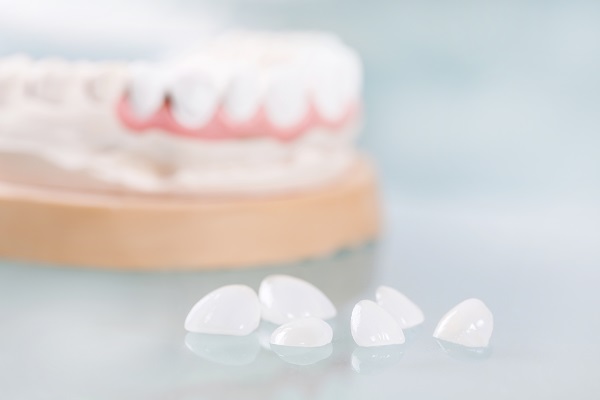 What Are Onlay Porcelain Dental Veneers?